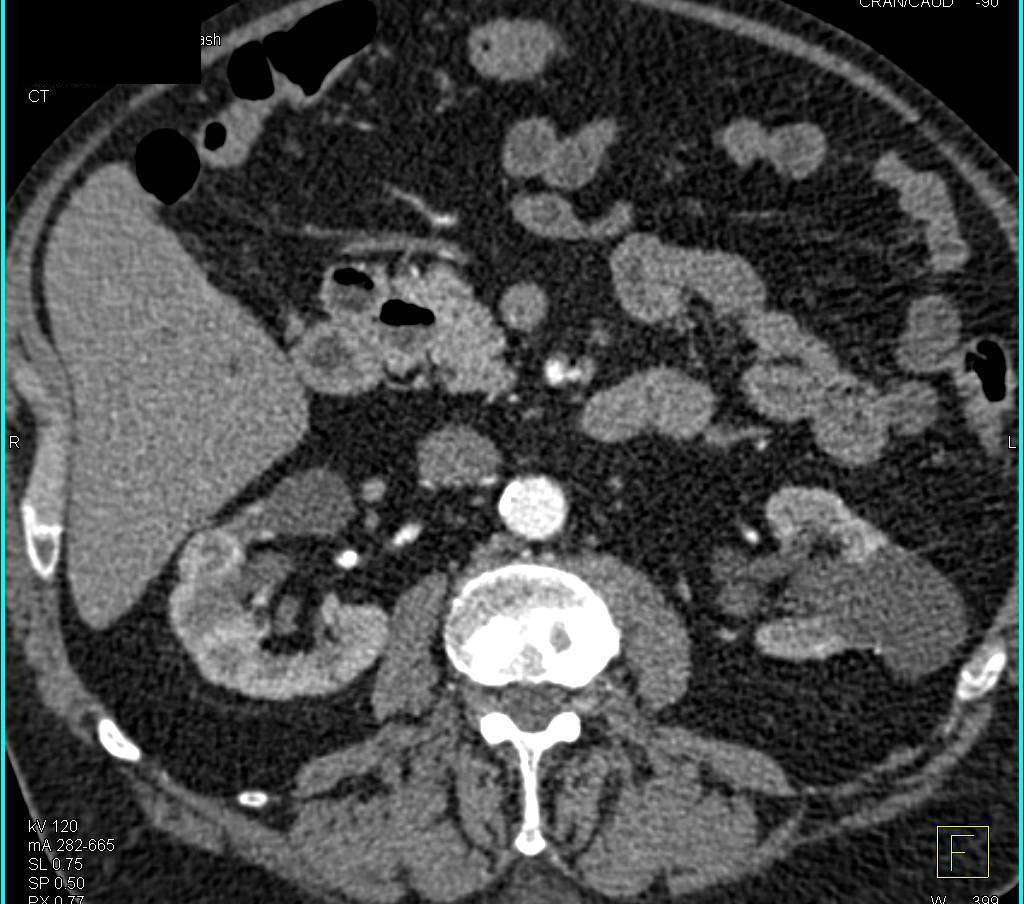 Multiple Cysts and Incidental Right Renal Cell Carcinoma - CTisus CT Scan