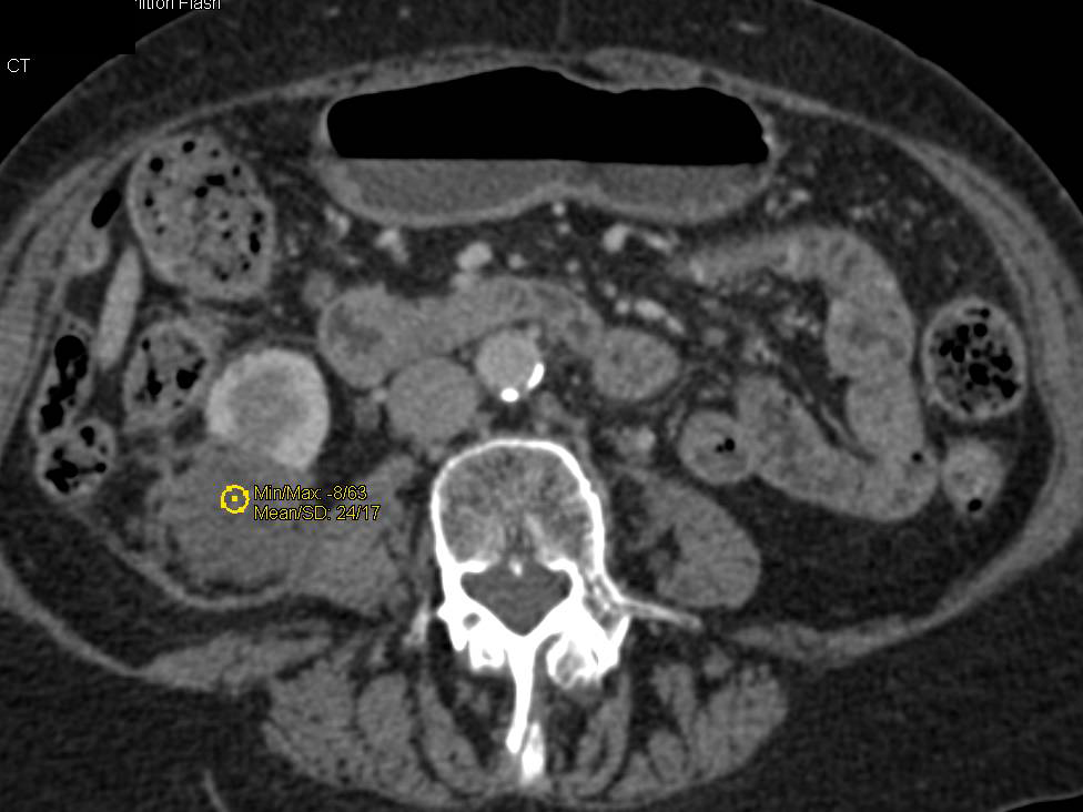 Radiofrequency Ablation (RFA) Changes Right Kidney - CTisus CT Scan