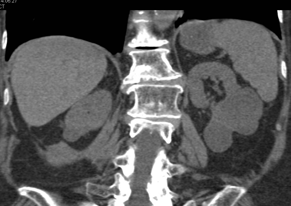 RF Ablation of a Mass of the Lower Pole of the Right Kidney - CTisus CT Scan