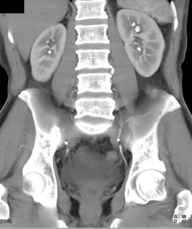 Bilateral Renal Calculi Seen on CT Urogram - CTisus CT Scan