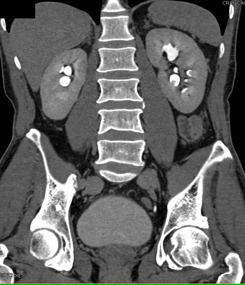Bilateral Renal Calculi Seen on CT Urogram - CTisus CT Scan