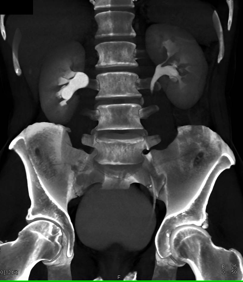 CT Urogram with Renal Calculi Seen by Adjusting Parameters - CTisus CT Scan