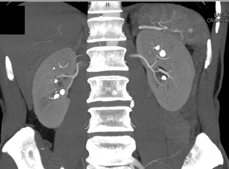 Small Non Obstructing Bilateral Renal Calculi