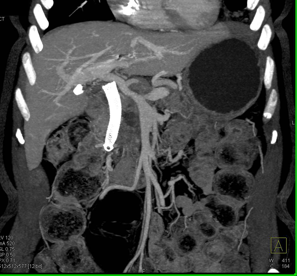 Cystic Left Renal Cell Carcinoma - CTisus CT Scan