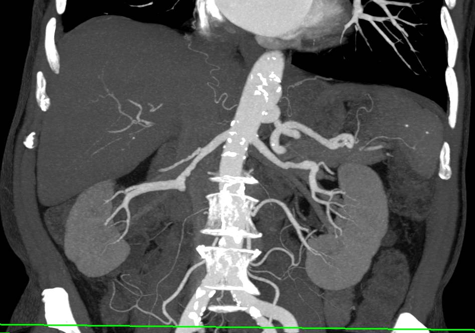 CTA with Incidental Bilateral Fibromuscular Dysplasia (FMD) of the Renal Arteries - CTisus CT Scan