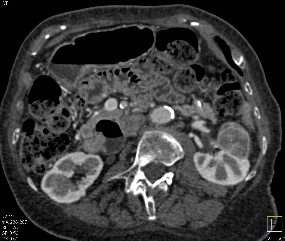 Transitional Cell Carcinoma Left Kidney in Multiple Phases - CTisus CT Scan