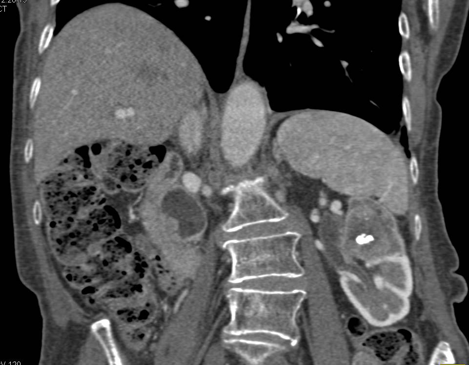 Transitional Cell Carcinoma of the Left Kidney - CTisus CT Scan