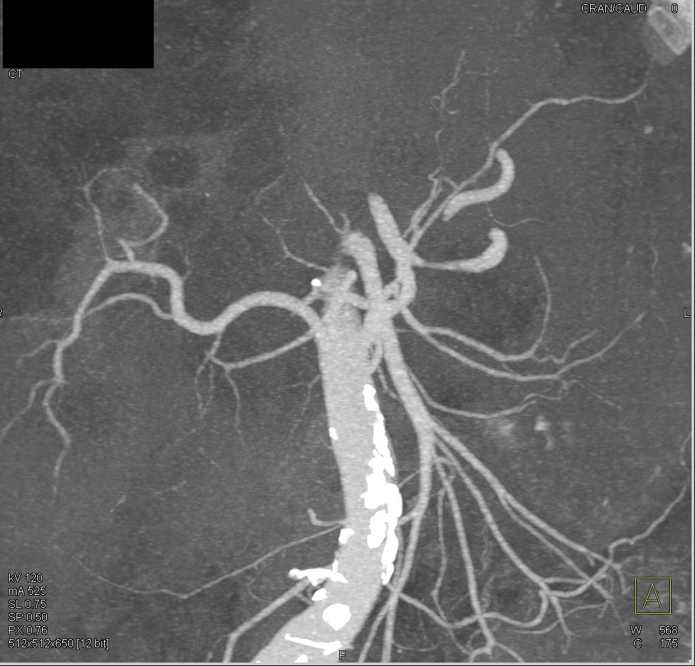 Polycystic Liver and Renal Disease  (PCLD and PCKD) - CTisus CT Scan