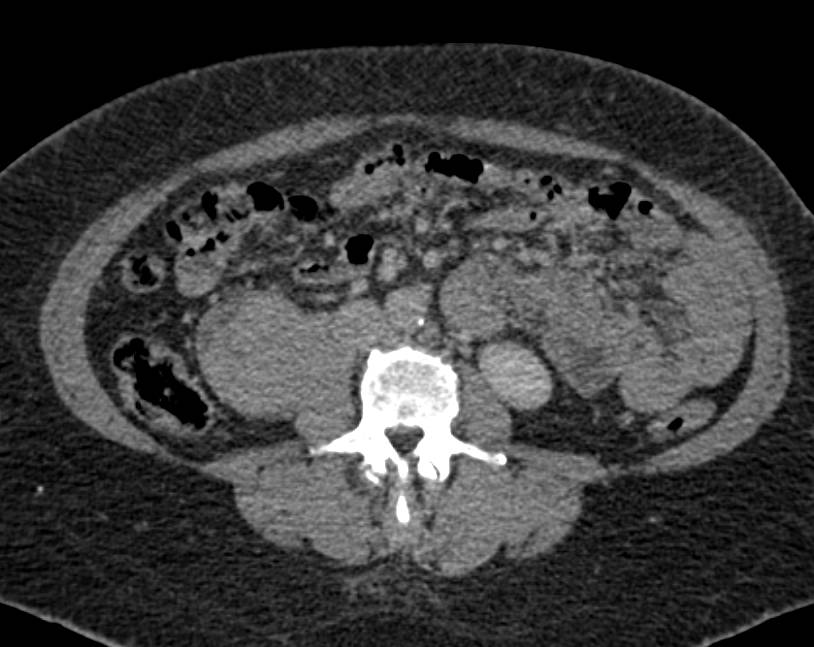 Recurrent Renal Cell Carcinoma in the Renal Bed - CTisus CT Scan