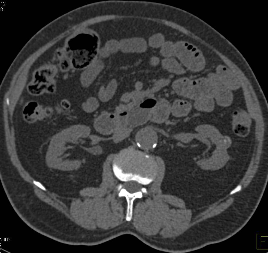 High Density Renal Cysts - CTisus CT Scan