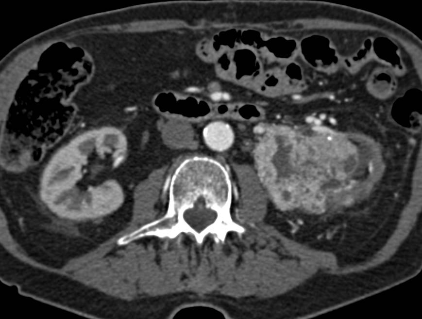 Clear Cell Renal Cell Carcinoma with Venous Invasion and Prior Embolization - CTisus CT Scan