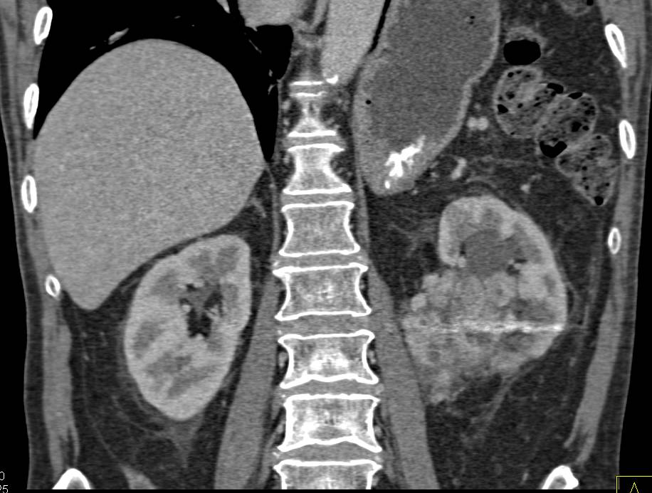 Vascular Renal cell Carcinoma Invades the Renal Vein. Prior Embolization - CTisus CT Scan