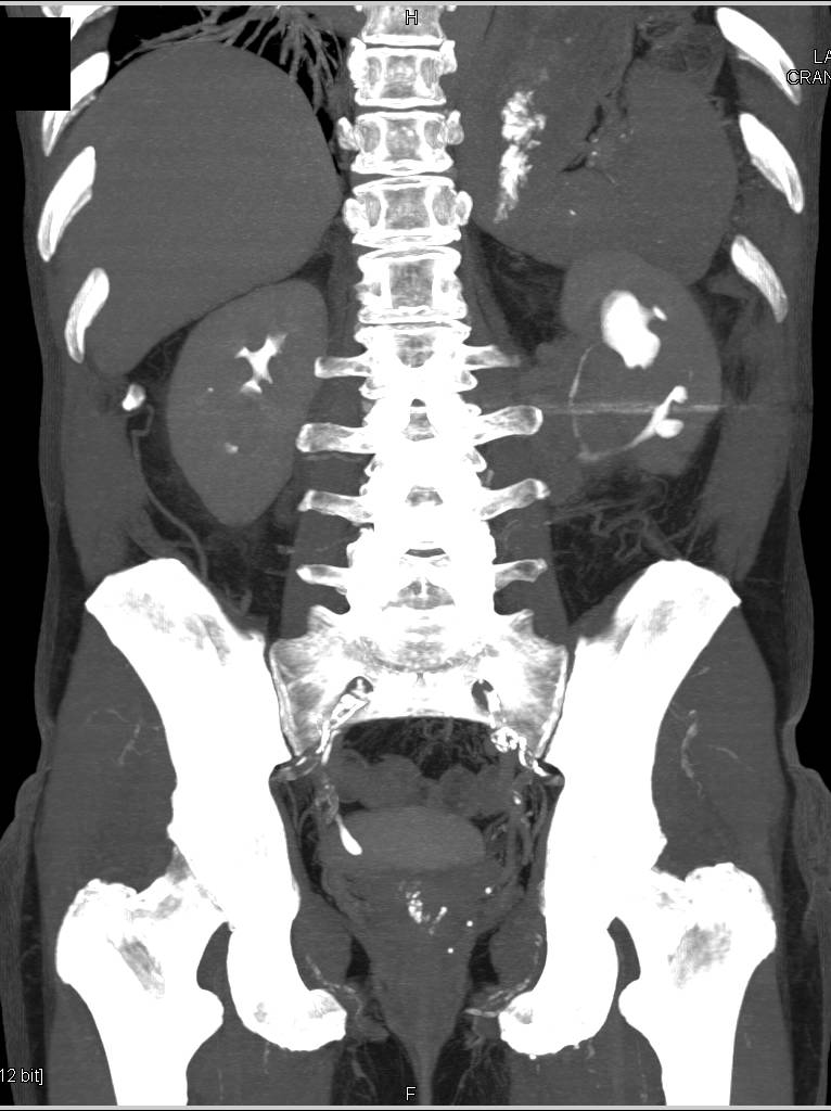 Renal Cell Carcinoma with Lung Metastases - CTisus CT Scan