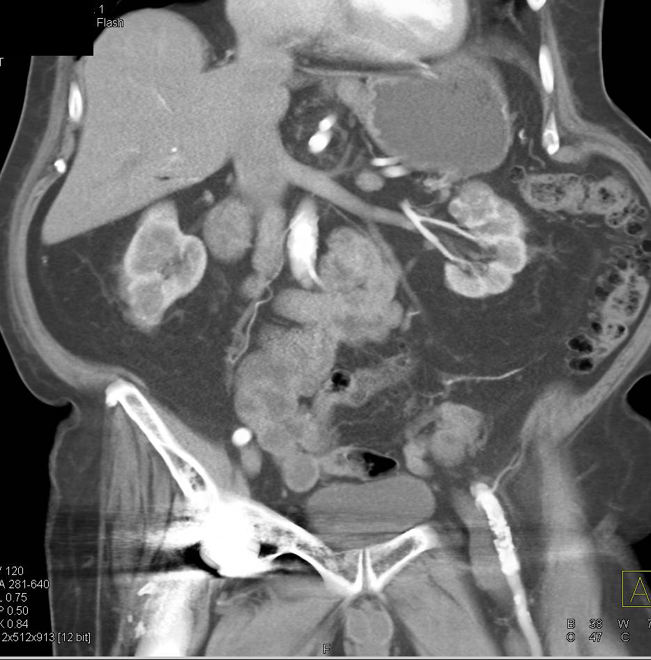 Bilateral Renal Cell Carcinomas - CTisus CT Scan