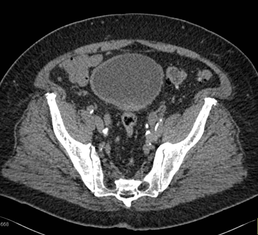 Right Hydronephrosis due to Bladder Cancer - CTisus CT Scan