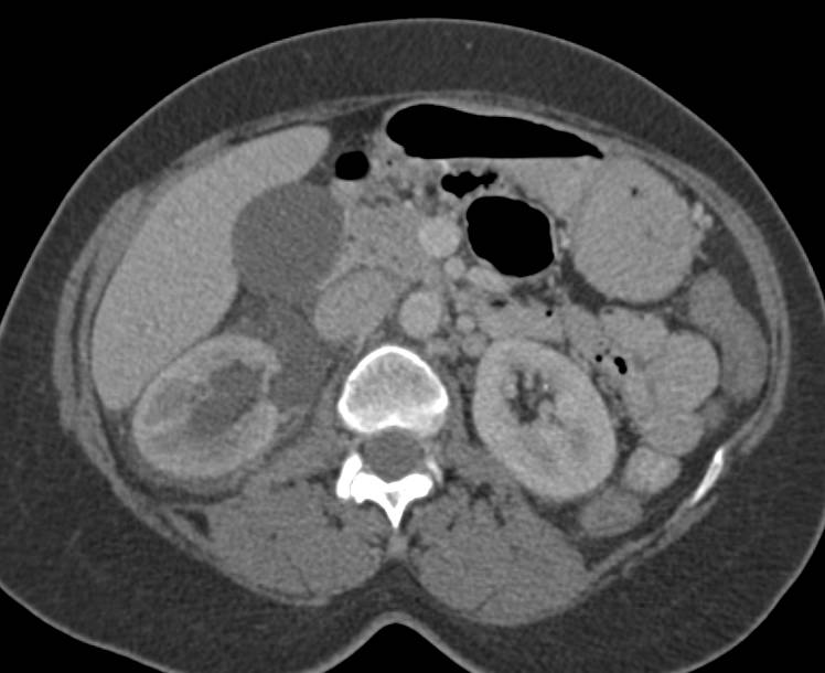 Obstructing Stone in Distal Left Ureter with Local Inflammation - CTisus CT Scan