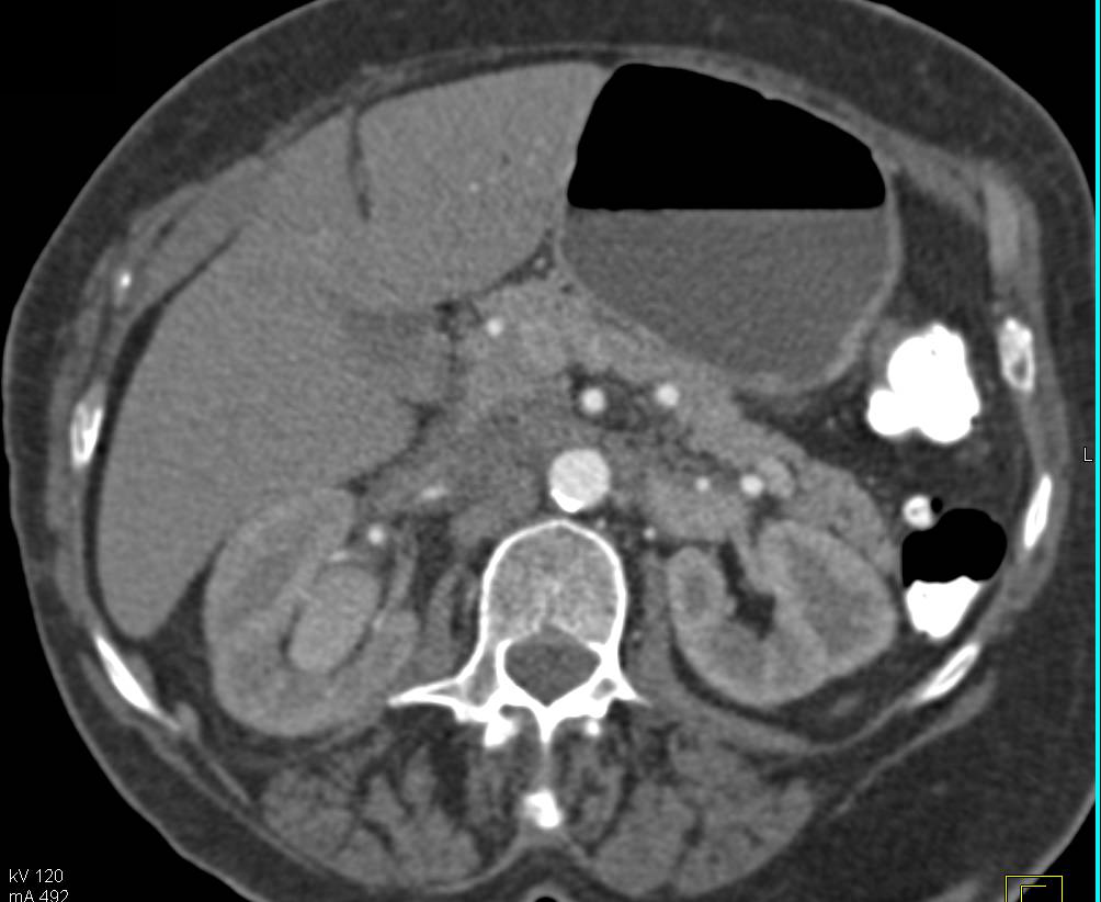 Transitional Cell Carcinoma Right Kidney - CTisus CT Scan