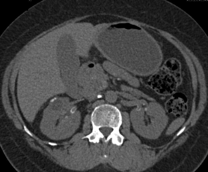 Vascular Calcifications in the Renal Arteries - CTisus CT Scan