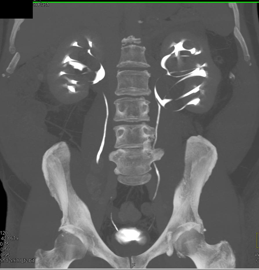 Multiple Parapelvic Cysts - CTisus CT Scan