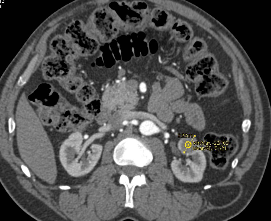 Borderline High Density Renal Cyst with Mild Enhancement - CTisus CT Scan