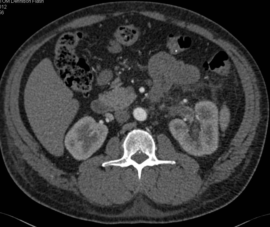 Classic Example of Renal Vein Thrombosis with Wall Enhancement - CTisus CT Scan