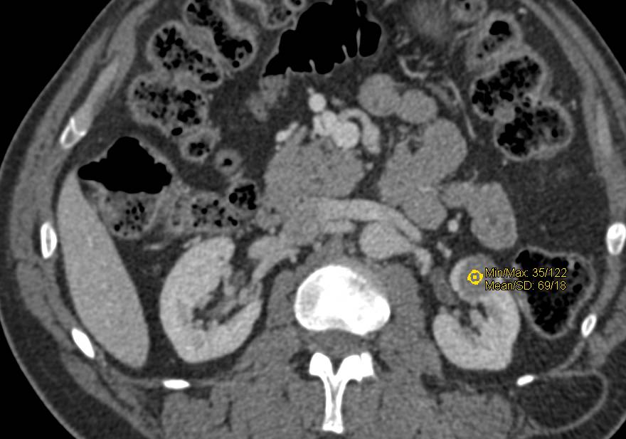 High Density Left Renal Cyst - CTisus CT Scan