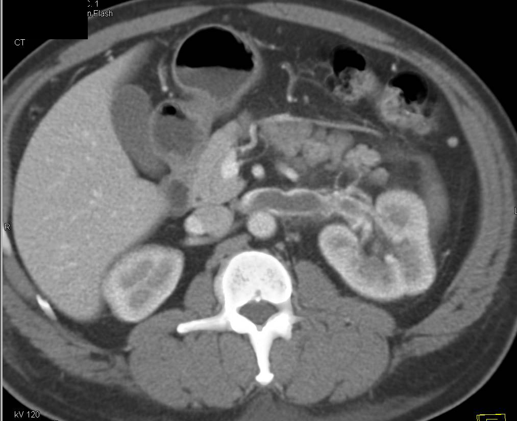 Excellent Example of Renal Vein Thrombosis and Pulmonary Embolism - CTisus CT Scan