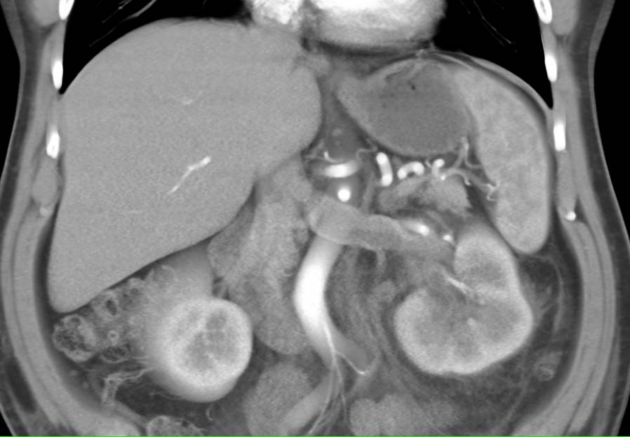 Acute Renal Vein Thrombosis - CTisus CT Scan