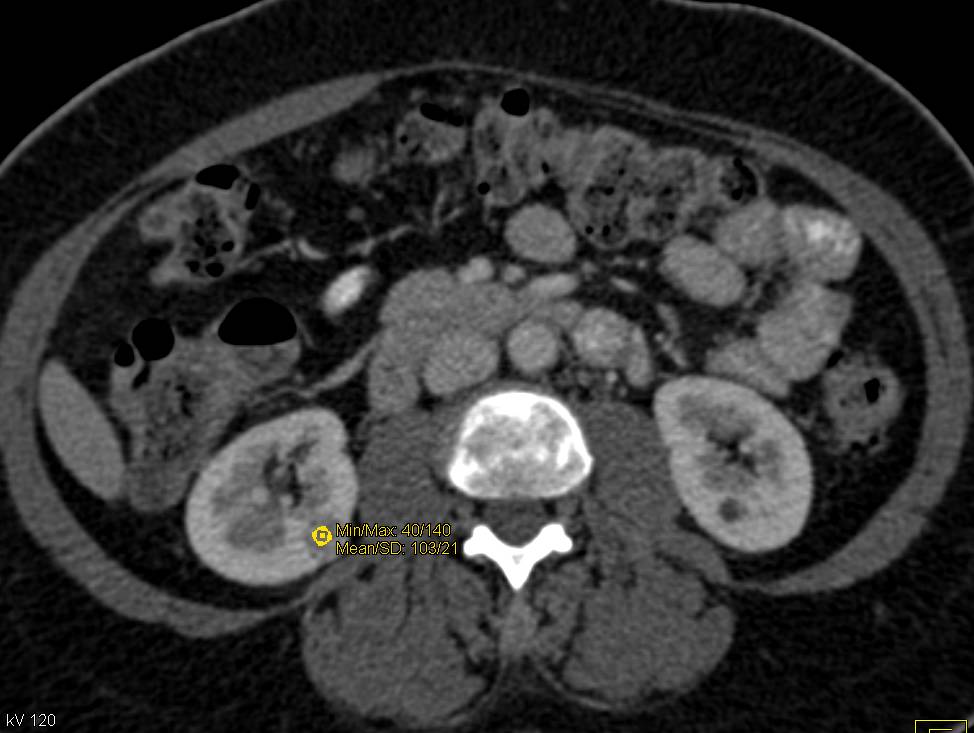 1 cm Papillary Renal Cell carcinoma Easy to Miss on Select Phases - CTisus CT Scan