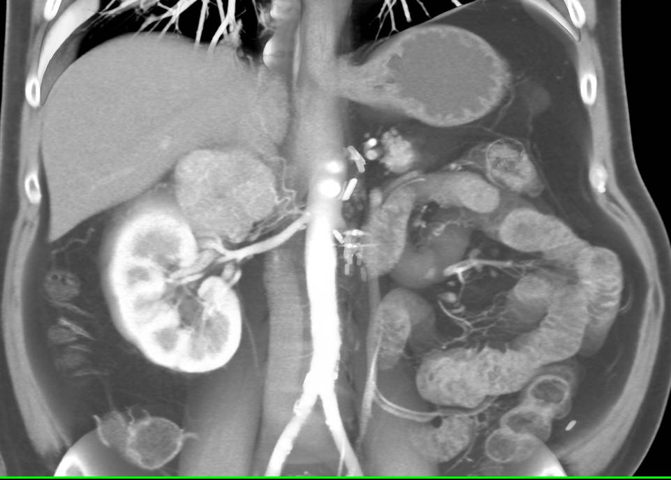 Metastatic Renal Cell Carcinoma to the Contralateral Adrenal Gland - CTisus CT Scan