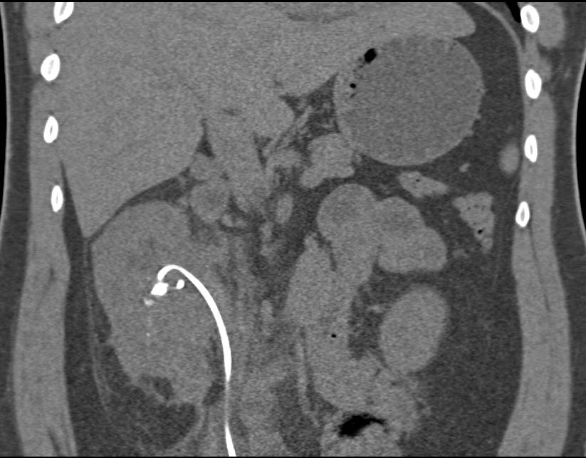 Perirenal Bleed and Small Renal Laceration S?P Lithotripsy for Renal Calculi - CTisus CT Scan