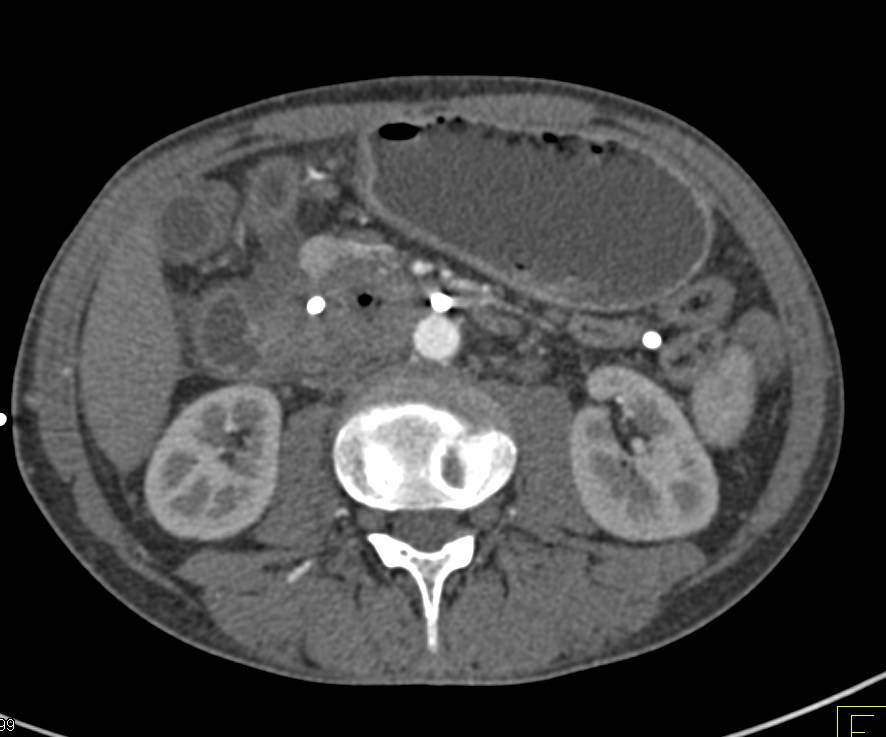 Incidental Right Renal Cell Carcinoma in a Patient with Duodenal cancer - CTisus CT Scan
