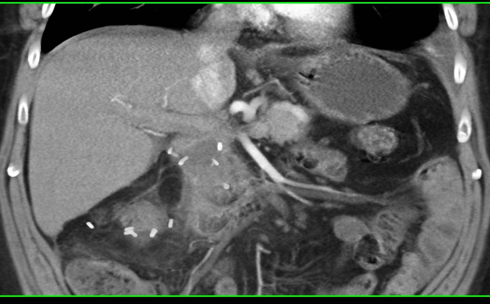 Liver Metastases in a Patient with Nephrectomy for Renal Cell Carcinoma - CTisus CT Scan