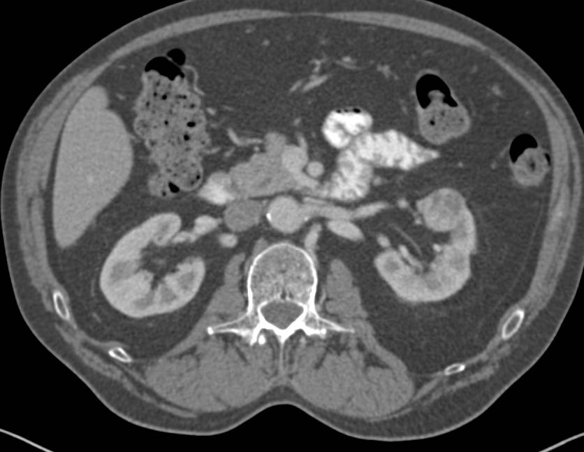 Subtle Left Papillary Renal Cell Carcinoma - CTisus CT Scan