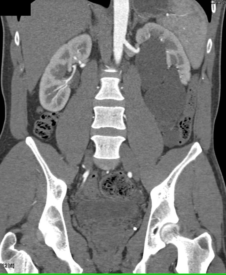 Parapelvic Cysts - CTisus CT Scan