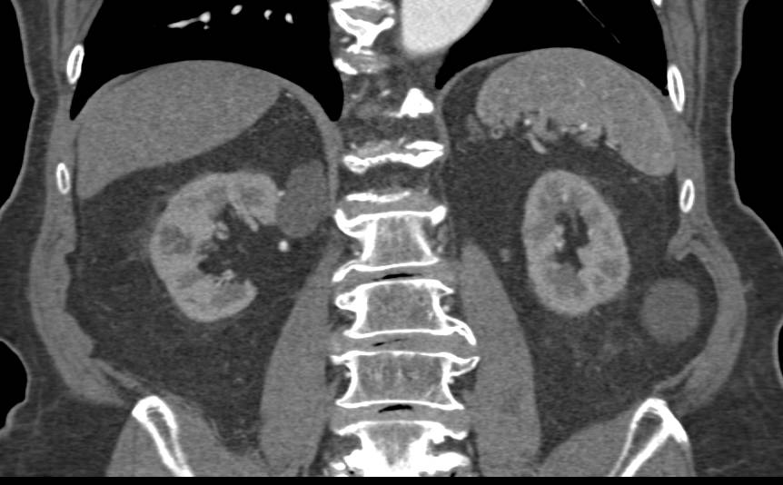 Bosniak I Cyst Right Kidney - CTisus CT Scan