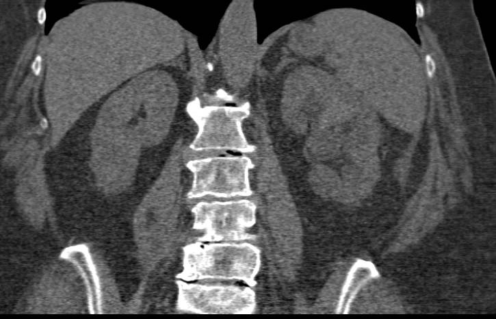 Transitional Cell Carcinoma Left Kidney with Blood Clots in the Bladder - CTisus CT Scan