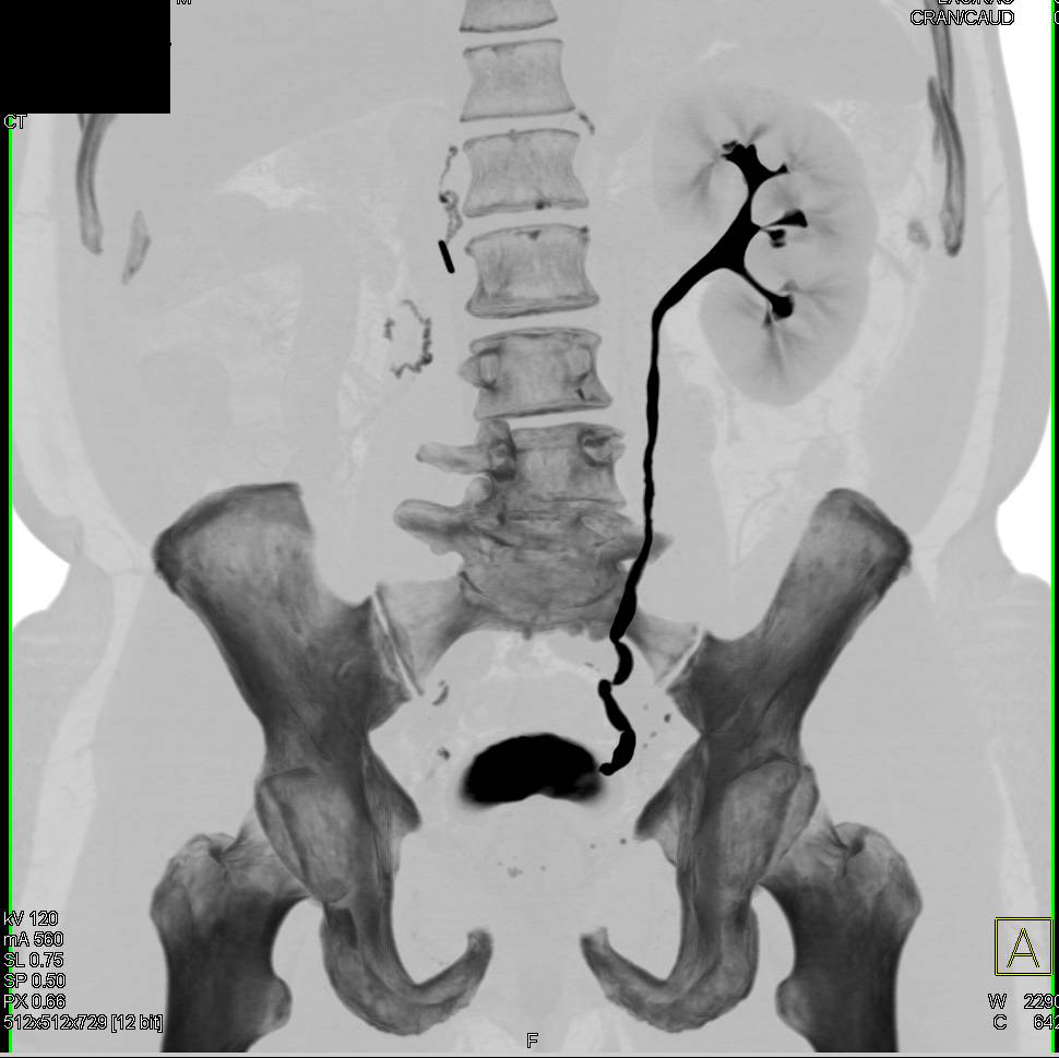 Right Nephrectomy with CT Urogram and 3D - CTisus CT Scan