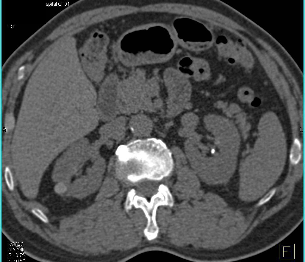 High Density Right Renal Cyst - CTisus CT Scan