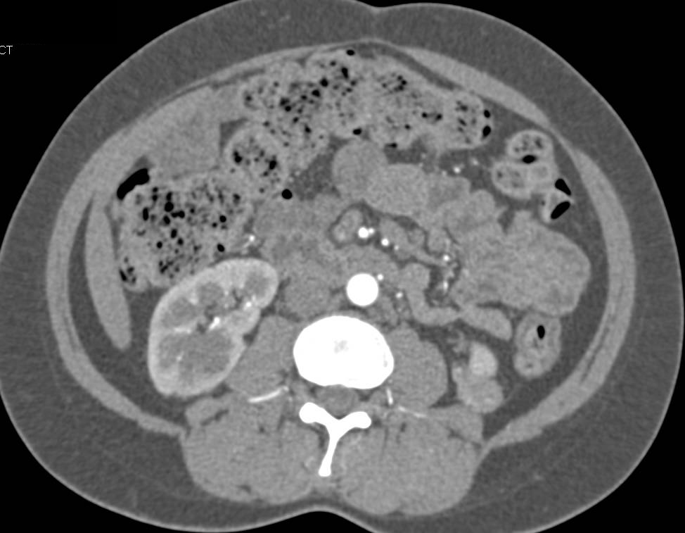 Papillary Renal Cell Carcinoma (RCC) Lower Pole of Left Kidney - CTisus CT Scan