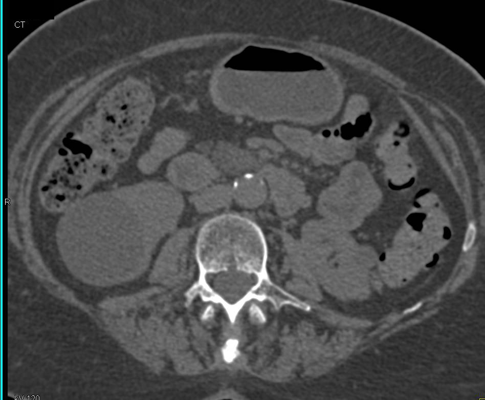 Renal Cysts - CTisus CT Scan