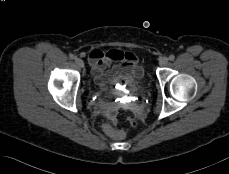 Duplicated Collecting System in 3D - CTisus CT Scan