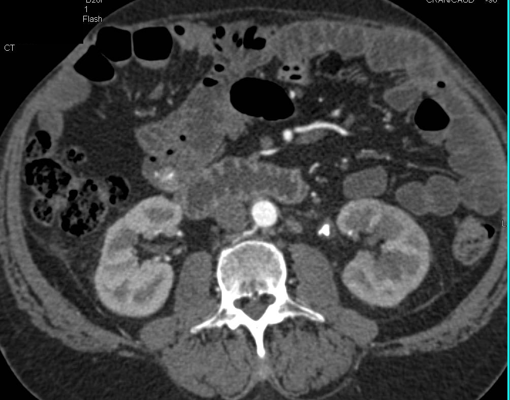 Stone in Proximal Left Ureter - CTisus CT Scan