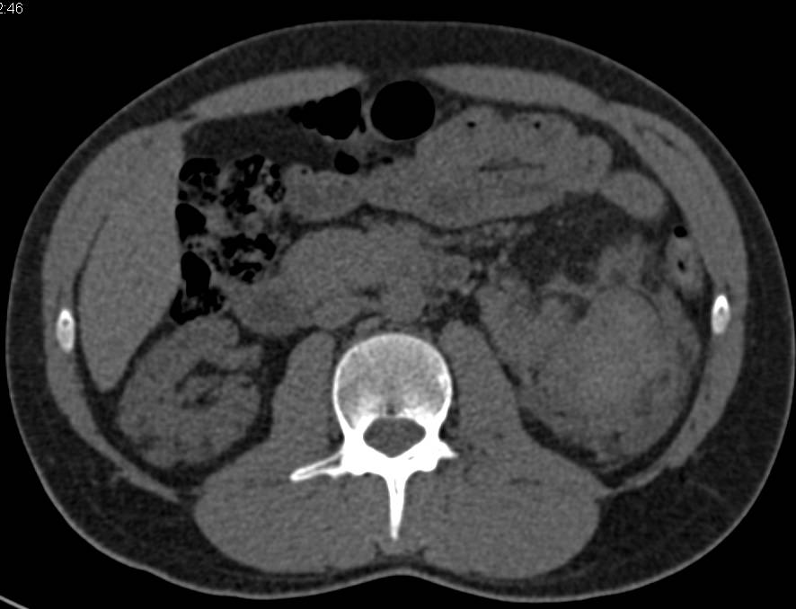 Multiple Renal Angiomyolipomas - CTisus CT Scan