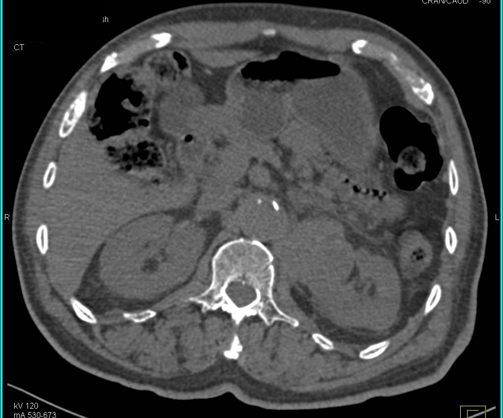 Papillary Renal Cell Carcinoma Left Kidney - CTisus CT Scan