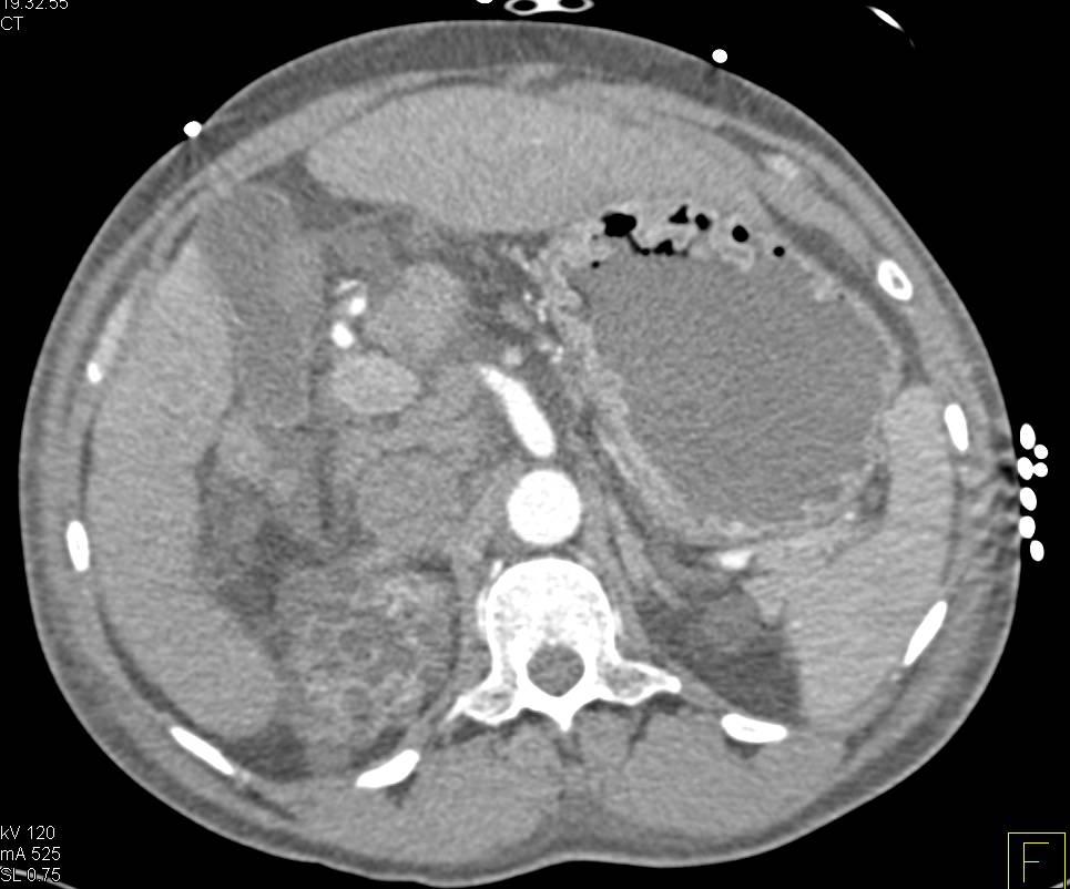 End State Renal Disease (ESRD) - Kidney Case Studies - CTisus CT Scanning