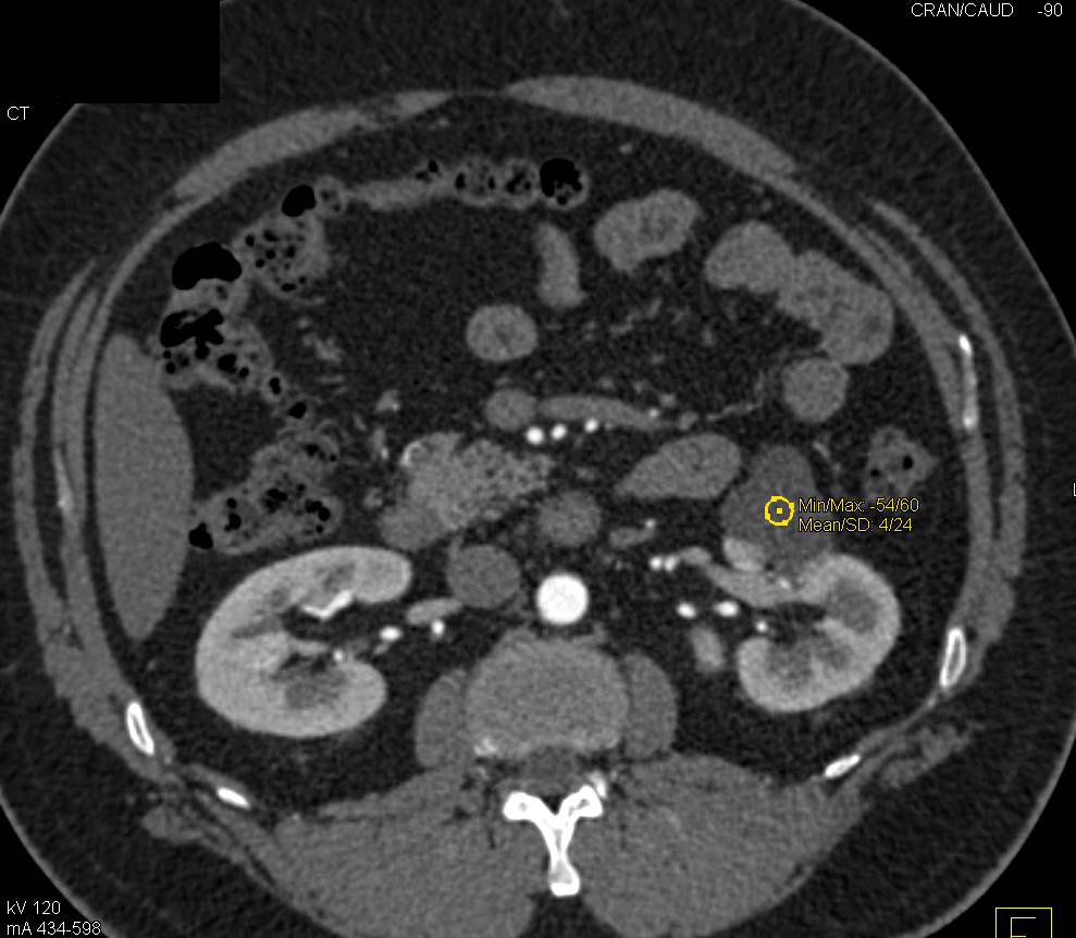 Simple Left Renal Cyst - Kidney Case Studies - CTisus CT Scanning