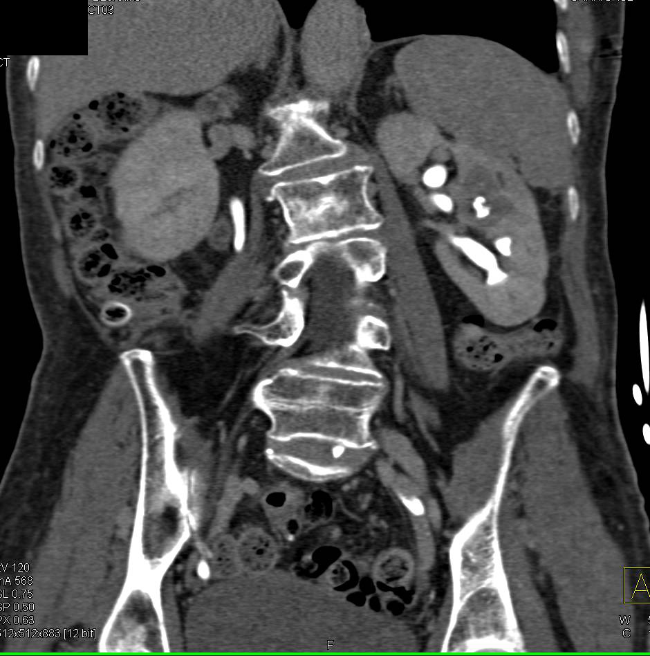 Subtle Transitional Cell Carcinoma Left Kidney - CTisus CT Scan