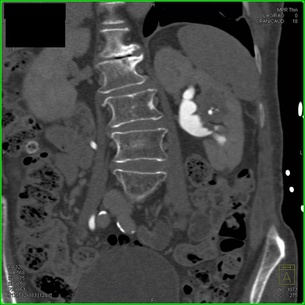 Transitional Cell Carcinoma Left Kidney - CTisus CT Scan