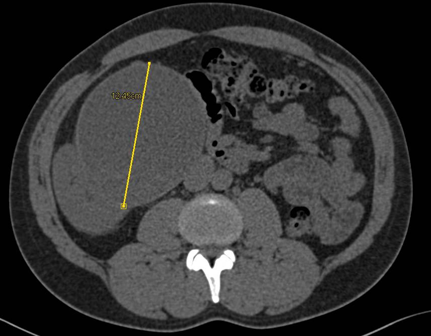 Complex Right Renal Cyst - CTisus CT Scan